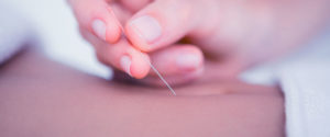 Acupuncture Acupuncture