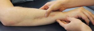 MSTR technique McLaughlin Scar Tissue Release Technique